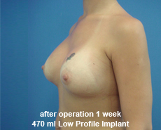plastic-surgery-breast-augmentation